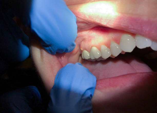 Best Emergency Care for Gum Disease in Clinton, LA